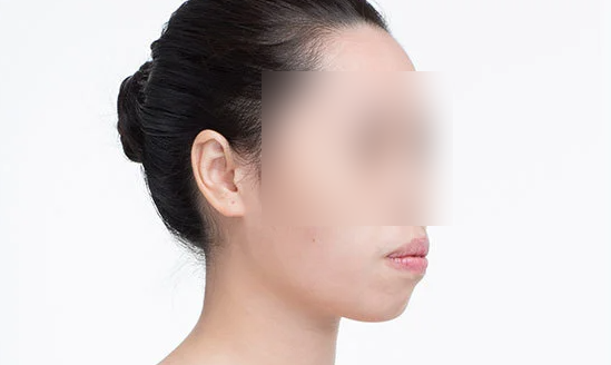 Protruding Mouth Laminate: Read This If Your Side Profile Has Been Especially on Your Mind image 2
