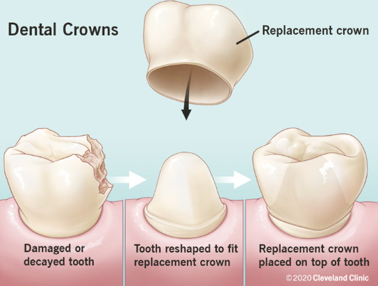 어금니크라운가격 궁금하세요 이것만큼은 알고 가세요 관련 이미지 3