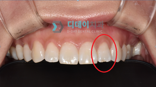 왜소치라미네이트? 앞니 치료사례 공개합니다. 관련 이미지 15