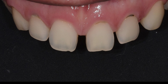 치간이개라미네이트, 벌어진 앞니 개선한 최신사례 관련 이미지 3