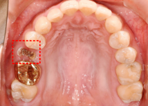 임플란트평생 사용 가능할까? 현직자가 공개합니다. 관련 이미지 1