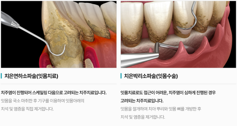 잇몸치료, 치과에서 꽁꽁 숨기는 치료라구요? 진실 알려드립니다. 관련 이미지 4