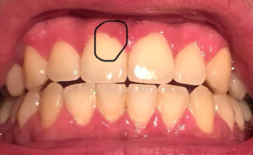 앞니충치치료, 2가지만 확인하면 됩니다 관련 이미지 3