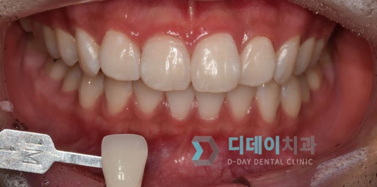 강남치아미백, 금세 또 착색되는 이유와 원데이 치료사례 관련 이미지 5