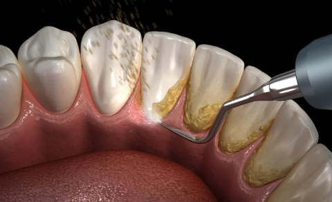 잇몸 부으면 치석 때문? 치아 흔들림의 이유 관련 이미지 8