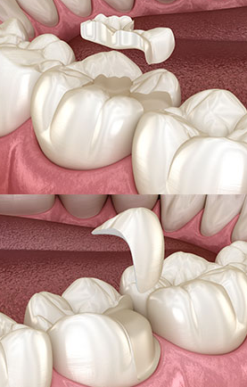 대치동 레진과 인레이 치료 어떤 경우에 사용할까 관련 이미지 6