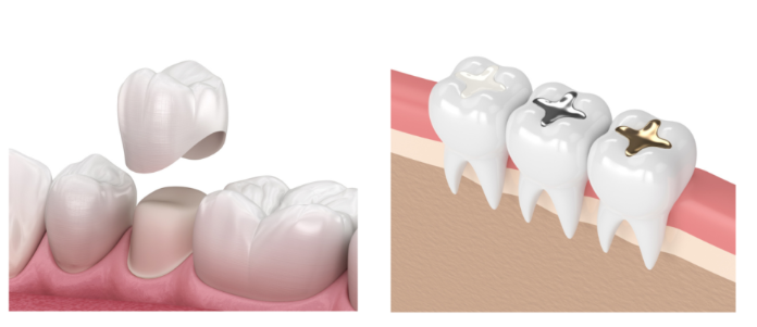 역삼동 크라운 치과 치료 필요한 치아상태, 꼭 확인하세요. 관련 이미지 8