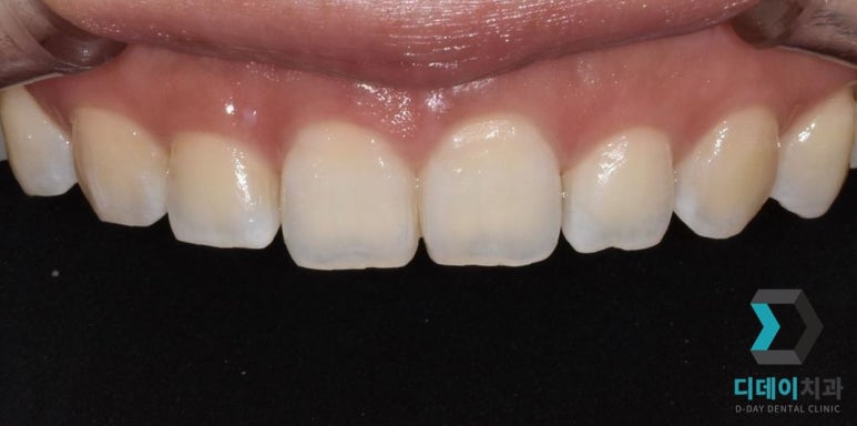 웃을 때 잇몸이 많이 보인다면, 몰라서 못하는 이것 관련 이미지 7