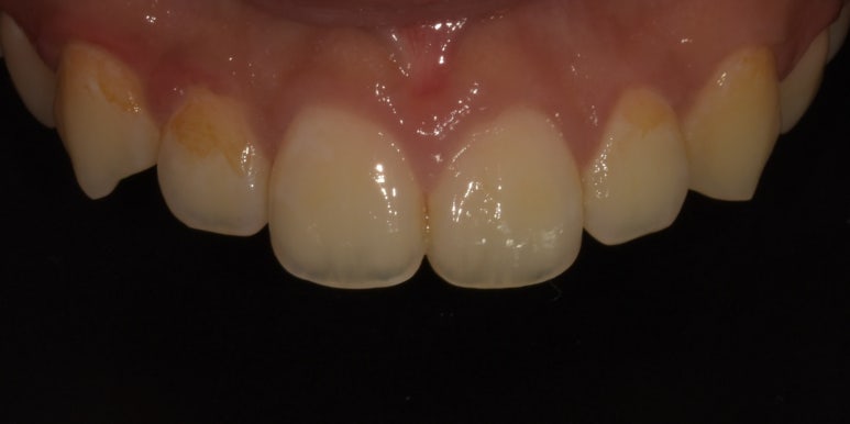 앞니모양 개선할 수 있는 2가지 치아성형방법 관련 이미지 8