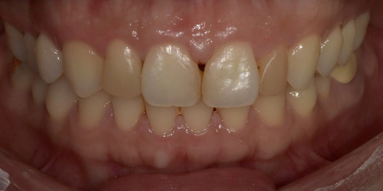 앞니레진수명, 얼마나 오래 사용할 수 있을까요? 관련 이미지 5