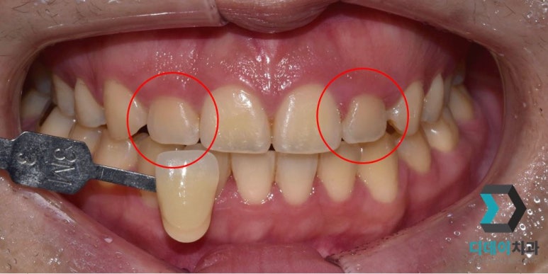 선릉역 잇몸성형, 가격보다 관련 이미지 3