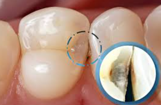 어금니충치치료비용, 병원마다 차이나는 진짜 이유 2가지 관련 이미지 5
