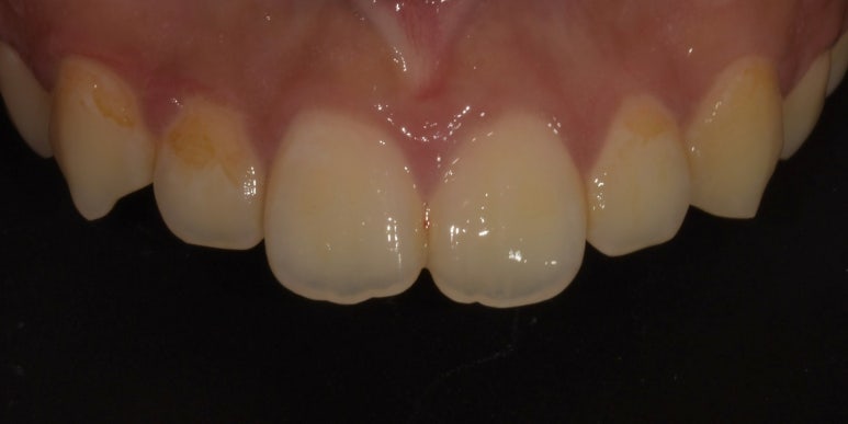 앞니모양 개선할 수 있는 2가지 치아성형방법 관련 이미지 5