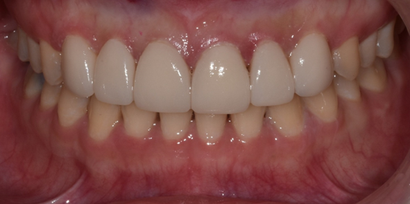 법랑질성형, 앞니 치아모양이 고민이라면 관련 이미지 7