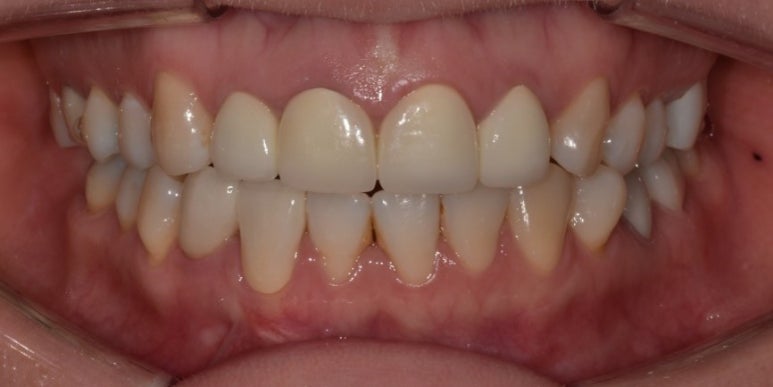 충치치료크라운 비용, 재료별 장단점까지 전부 공개 관련 이미지 7