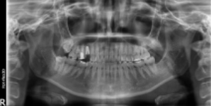 임플란트평생 사용 가능할까? 현직자가 공개합니다. 관련 이미지 2