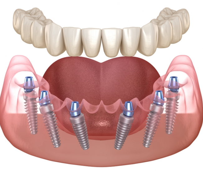 40대 전체 임플란트, 아직 젊은데 치아를 전부 발치해야만 하는 걸까? 관련 이미지 10