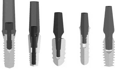 임플란트구조, 의사가 알려주는 2가지 핵심 구성요소 관련 이미지 5