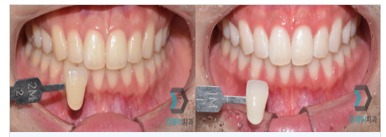 자가치아미백 VS 전문가 치아미백, 차이를 알고 하셔야합니다. 관련 이미지 3