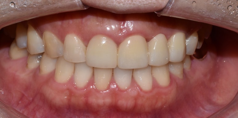 앞니브릿지, 치료기간 앞니 없이 생활해야하나요? 관련 이미지 5