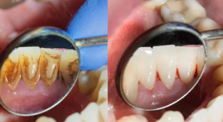 강남역스케일링, 미루면 치료비 10배 더 나옵니다 관련 이미지 6