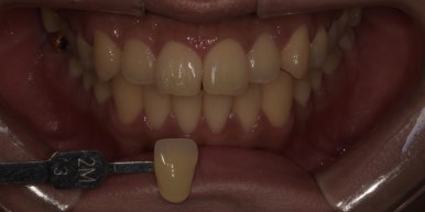 라미네이트 전후사진과 치료비용까지 숨김없이 알려드립니다. 관련 이미지 16