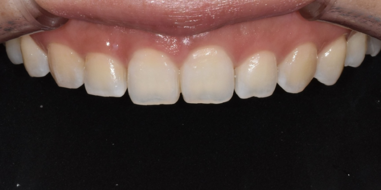 잇몸성형가격? 비용, 주의사항, 치료 후기 공개 관련 이미지 7