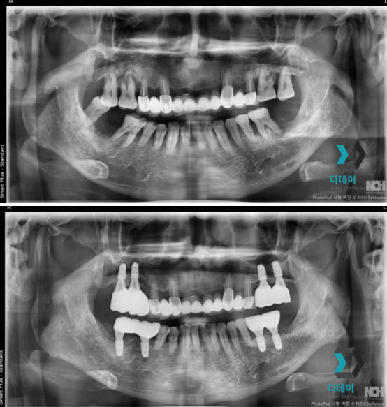 언주역치과, 임플란트 실력 있는 곳은 이 2가지에서 확 차이납니다 관련 이미지 3