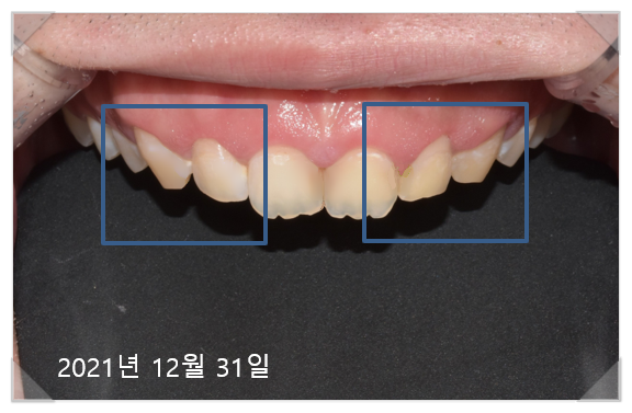 잇몸수술비용? 이 글로 종결합니다. 관련 이미지 7