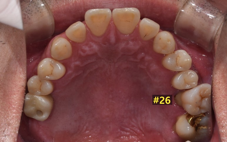 상악동거상술과 뼈이식임플란트 실제 치료사례로 보여드립니다. 관련 이미지 5