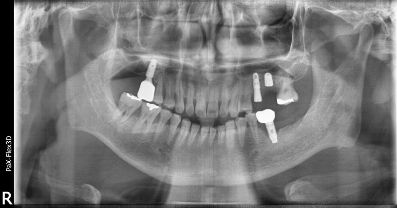 상악동거상술과 뼈이식임플란트 실제 치료사례로 보여드립니다. 관련 이미지 6
