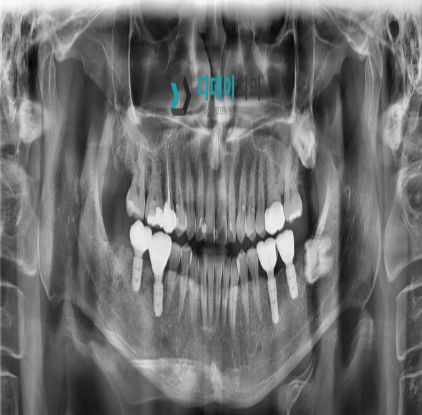 강남역 치과 임플란트 수면마취?해야만 하는 경우 관련 이미지 3