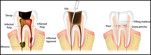 충치초기치료, 병원마다 치료법이 다른 이유 관련 이미지 2