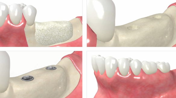 치조골 증대술 , 베테랑들도 어려워하는 이유 관련 이미지 6