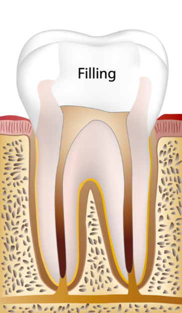 신경치료고통? 통증을 줄이는 방법은 바로 OO입니다. 관련 이미지 11