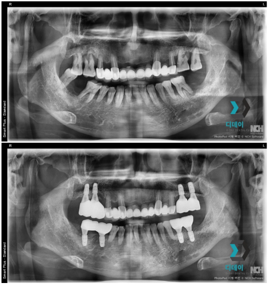 대치역치과 임플란트 잘하는 곳, 경력보다 중요한 것 관련 이미지 7