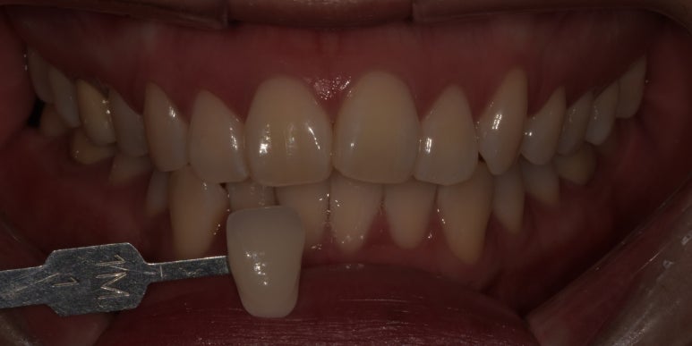 치과치아미백? 연예인처럼 새하얀 치아 못 만듭니다. 관련 이미지 5