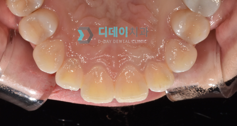 앞니살짝깨짐 이 1가지만 확인하면 치료 방향 결정됩니다 관련 이미지 4