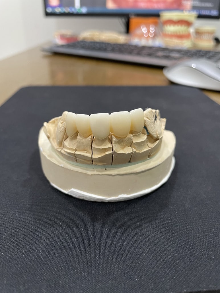 앞니브릿지, 임플란트와의 차이점과 가격까지 비교분석 관련 이미지 2