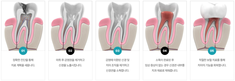 PFM? 지르코니아? 치아색 크라운 전격 해부 관련 이미지 7