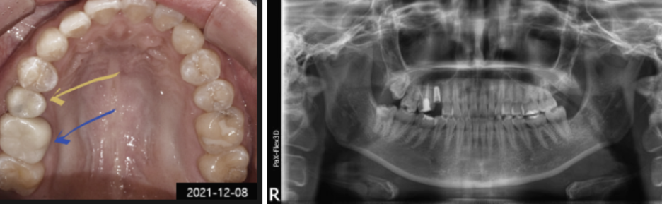 크라운을 임플란트로 교체한 이유 <치료사례> 관련 이미지 2