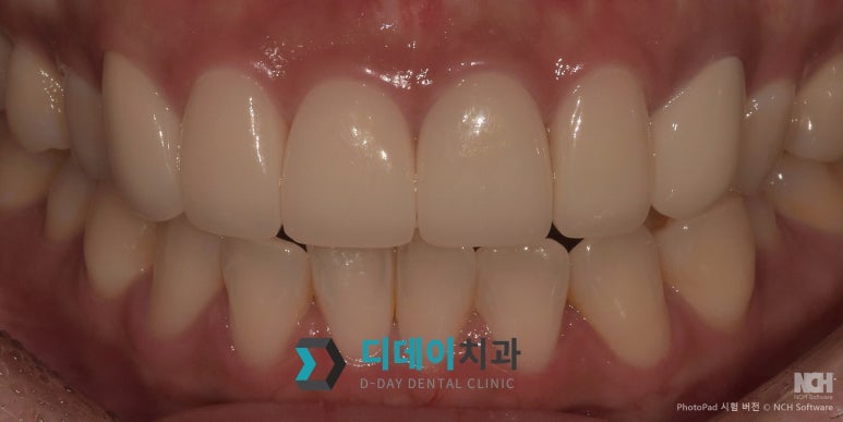 어금니크라운가격 궁금하세요 이것만큼은 알고 가세요 관련 이미지 8
