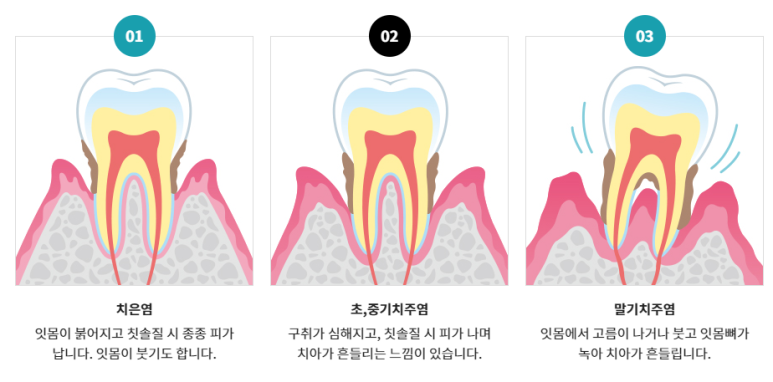 임플란트에도 충치가 생긴다? Yes or No? 관련 이미지 5