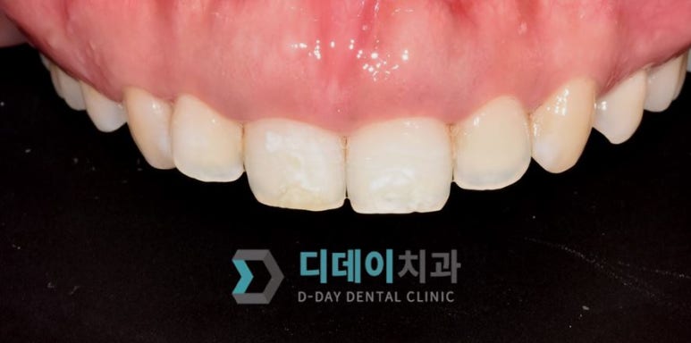 치아성형 종류, 비용, 장단점까지 완벽정리 관련 이미지 11