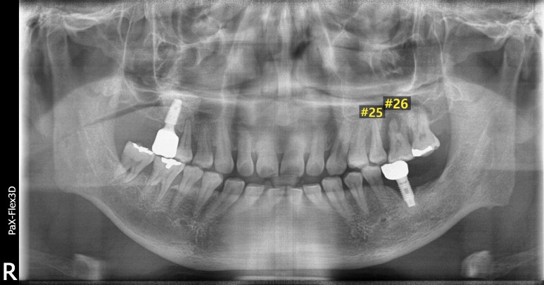 상악동거상술과 뼈이식임플란트 실제 치료사례로 보여드립니다. 관련 이미지 2