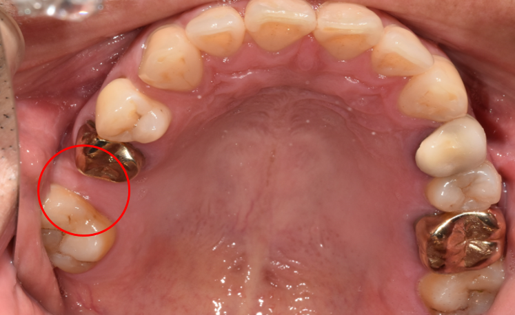 청담역치과? "뼈이식 없이" 임플란트 진행 사례 관련 이미지 6