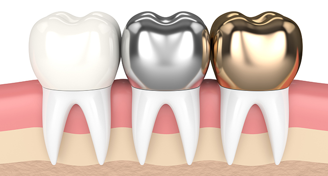 골드크라운비용? 장단점과 수명까지 한번에 정리해드립니다. 관련 이미지 3