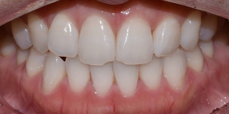 라미네이트치아삭제때문에 고민? 이것 확인하고 결정하세요 관련 이미지 5