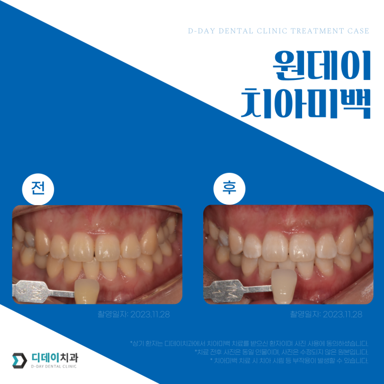치아미백비용, 치과가 10배 비싼데도 시술하는 이유? 관련 이미지 5