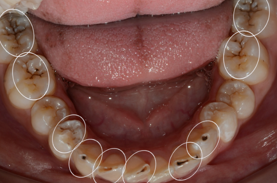 아랫니충치, 치료 미루면 안 되는 이유 2가지 관련 이미지 6